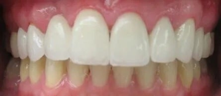 Bridge Smile Gallery After