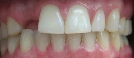 Bridge Smile Gallery Before