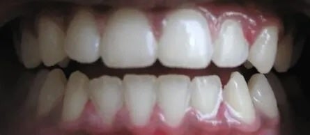 Invisalign Smile Gallery After