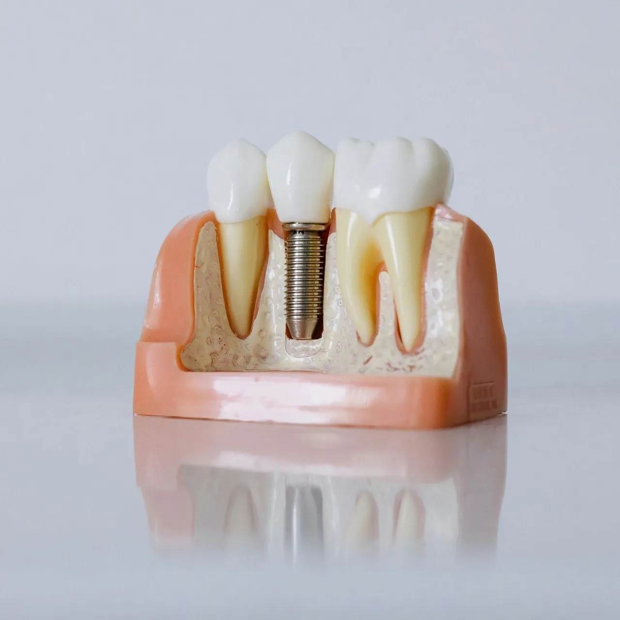 Dental Implants in Huntington Beach