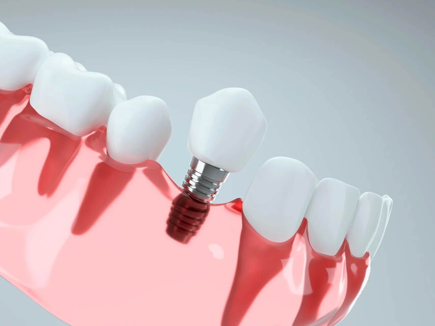 Dental Implants in Huntington Beach