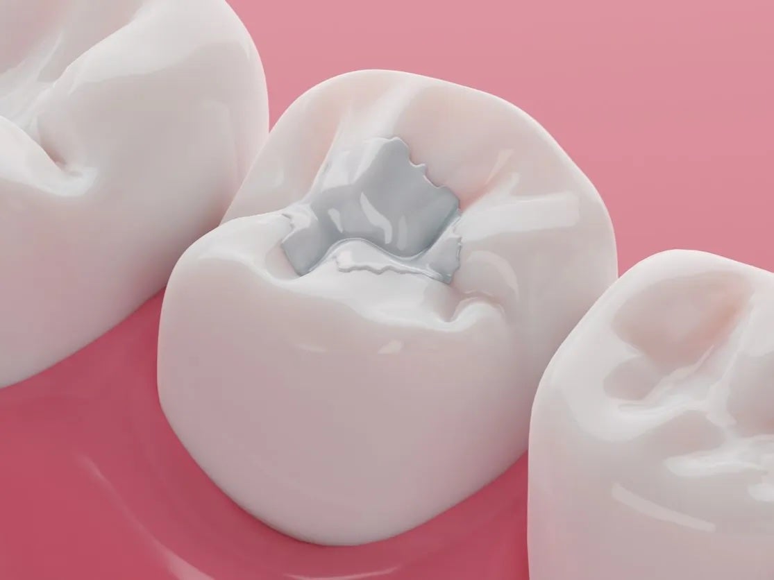 Tooth Fillings in Huntington Beach