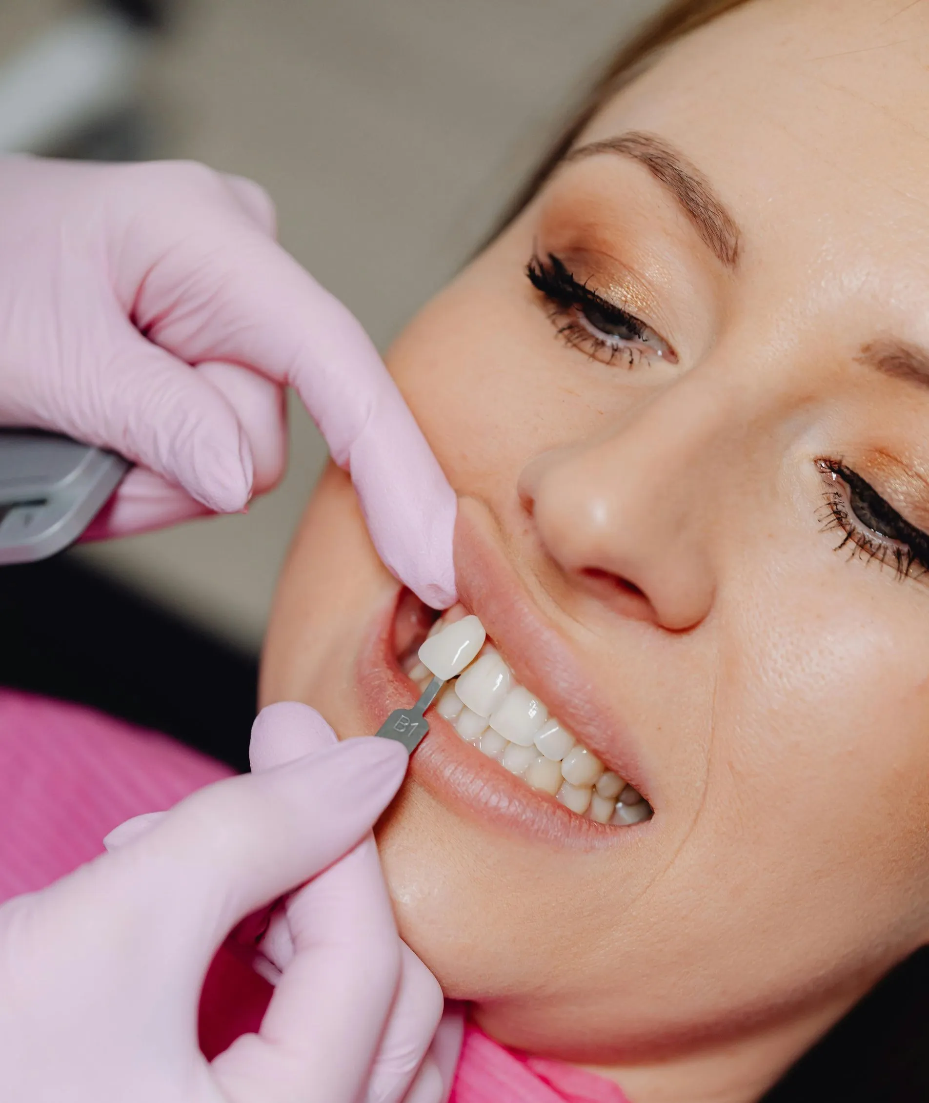 Veneers in Huntington Beach
