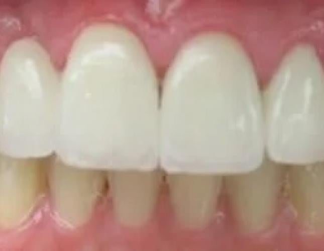 Bridge Smile Gallery After