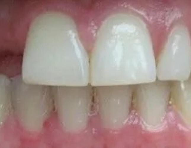 Bridge Smile Gallery Before