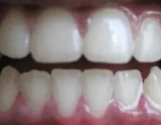 Invisalign Smile Gallery After