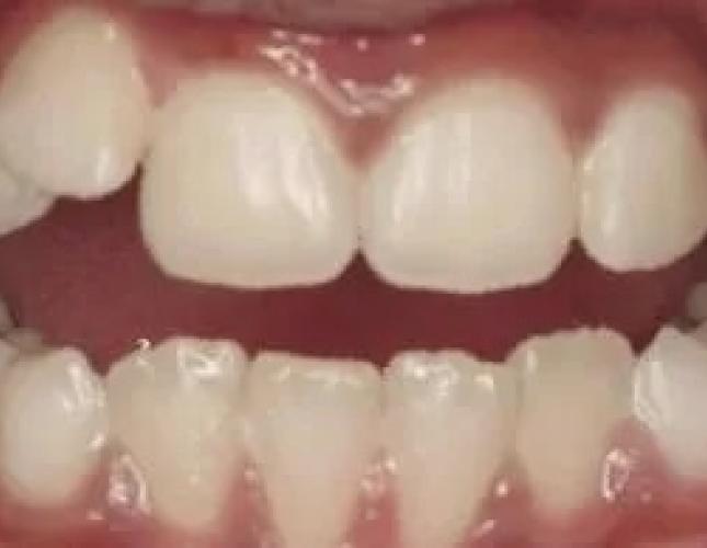 Invisalign Smile Gallery Before